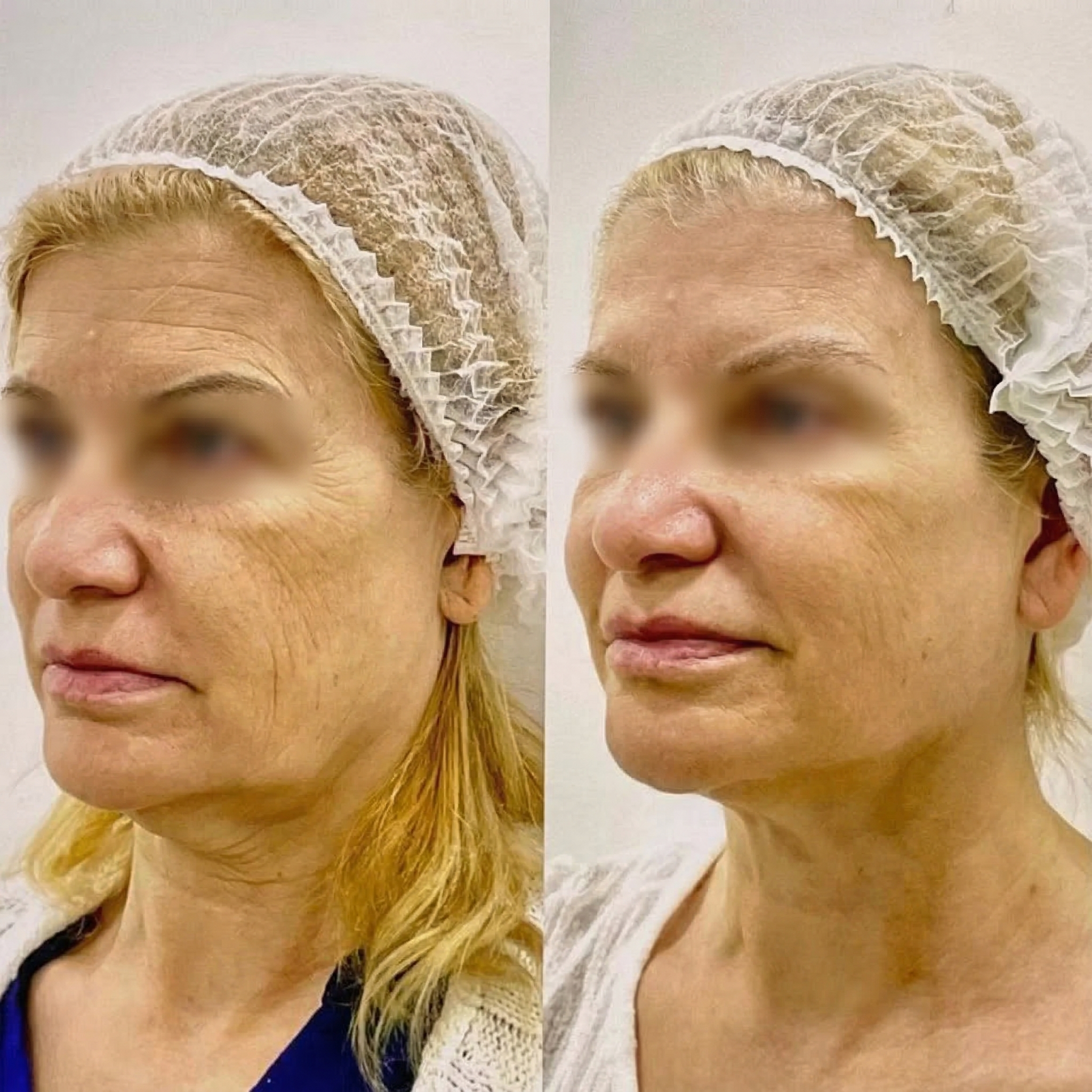 Antes y Después Paciente 1