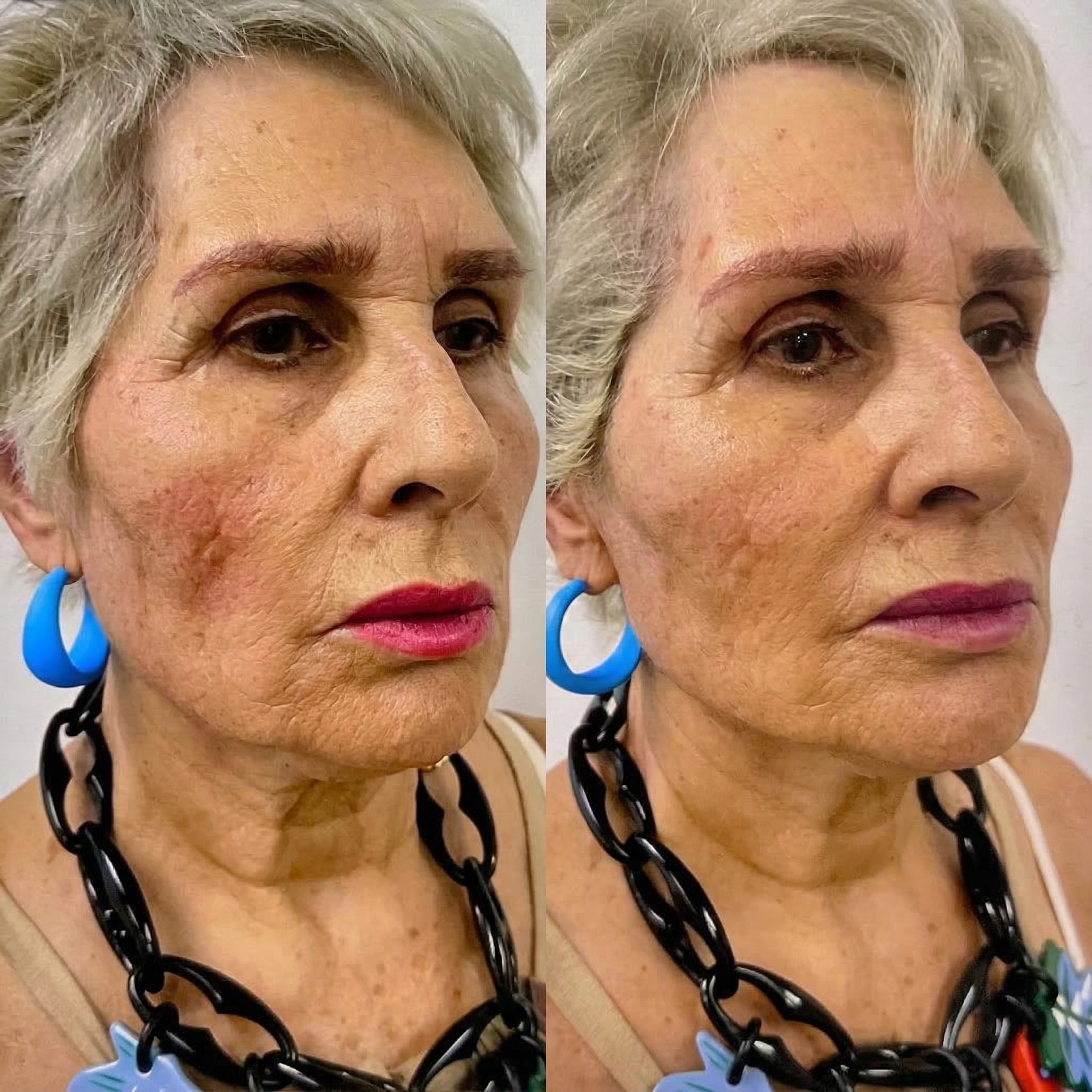 Antes y Después Paciente 2